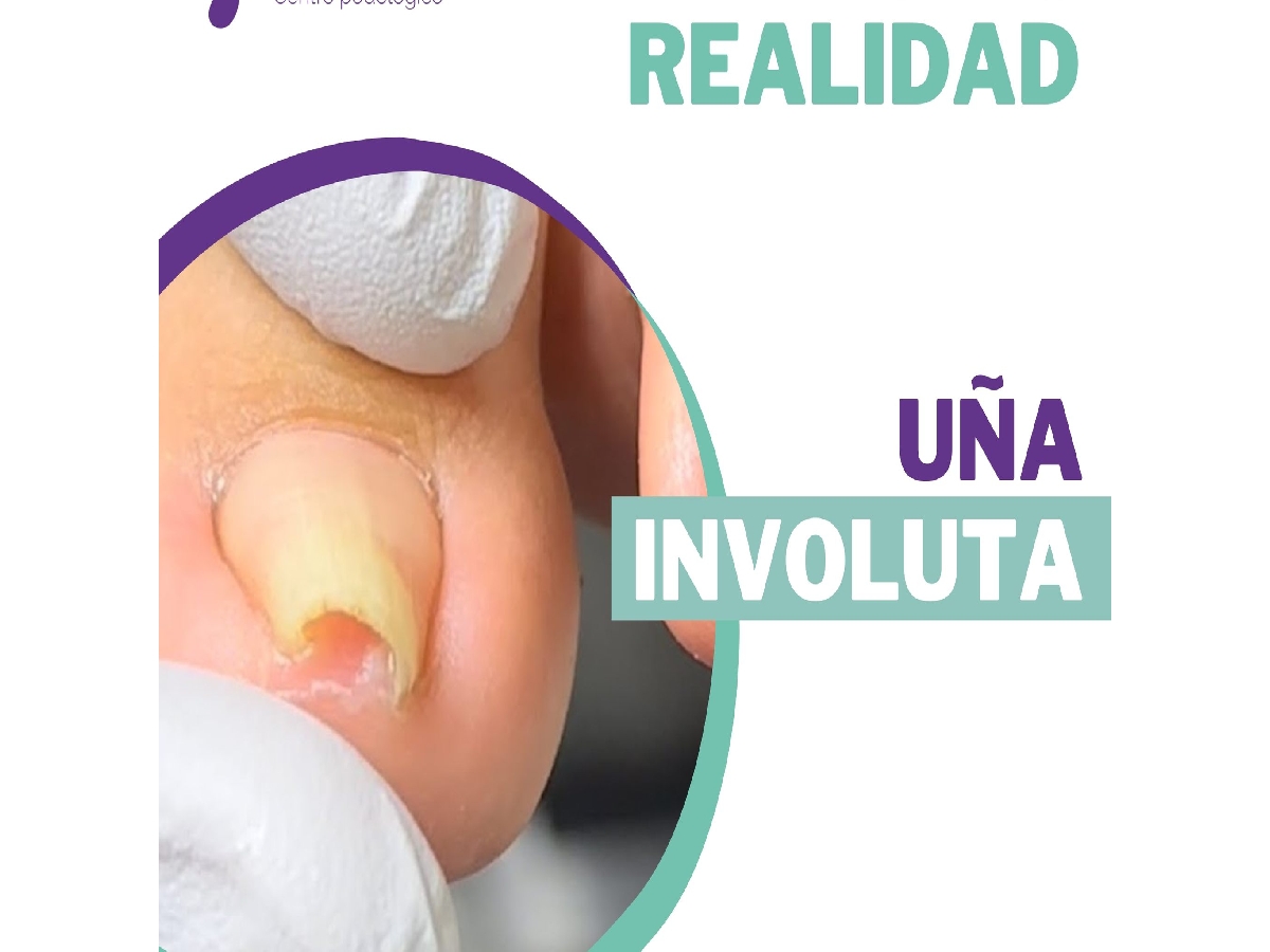 correcion de la mala formacion de las u as ortonixia